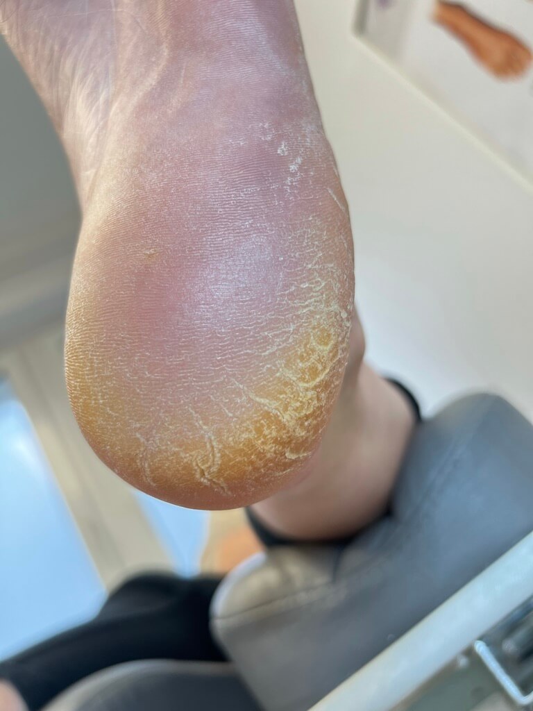 terapia pAkajAcych piAt przed